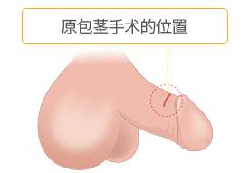 Incising 1.5~2cm long in the existing circumcision area