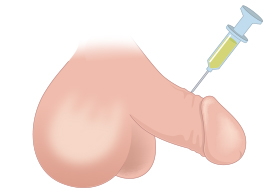 Injecting fillers at penis