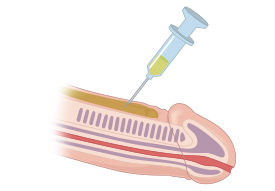 Injecting into the fascia layer of the penis overall