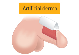 The inside of the incision was minutely detached, and implanting artificial derma