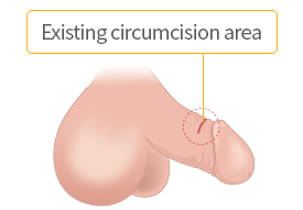 Incising 1.5~2cm long in the existing circumcision area