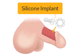 Preparing silicone implant