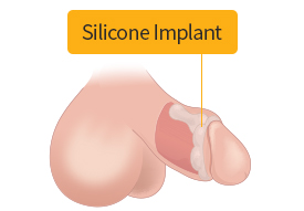 Inserting silicone implant