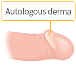 Enlarging glans after inserting autologous derma to glans only