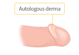 Enlarging glans after inserting autologous derma to glans only