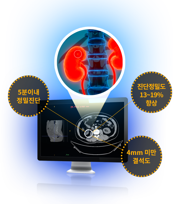 5분이내 정밀진단, 진단정밀도 13~19% 향상, 4mm 미만 결석도