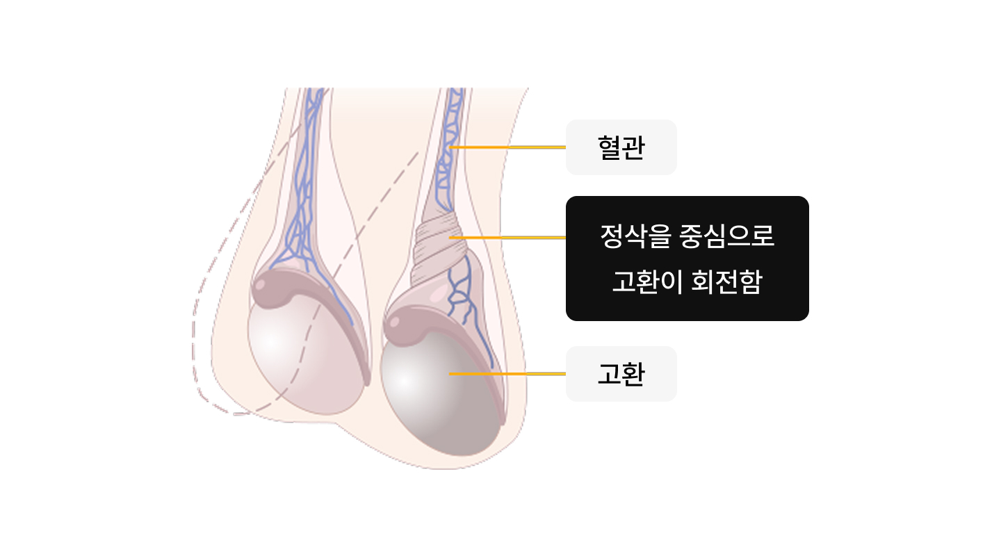 고환염전 일러스트