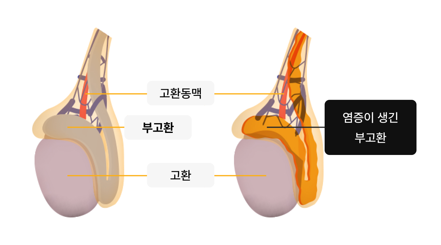 급성부고환염 일러스트