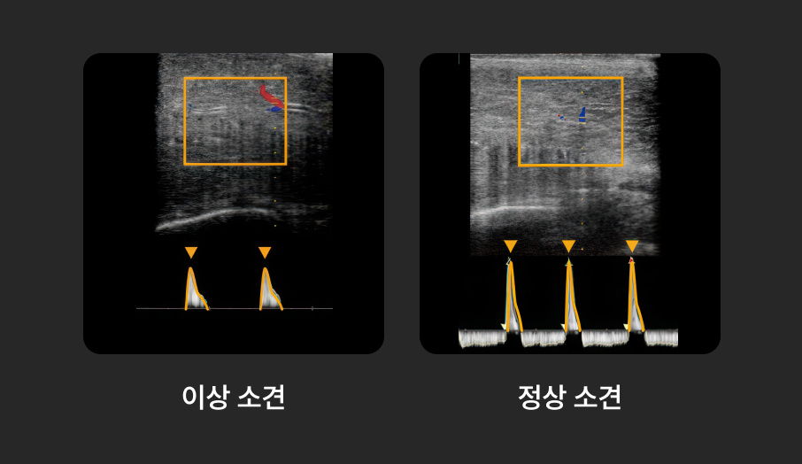 도플러 초음파 검사 화면
