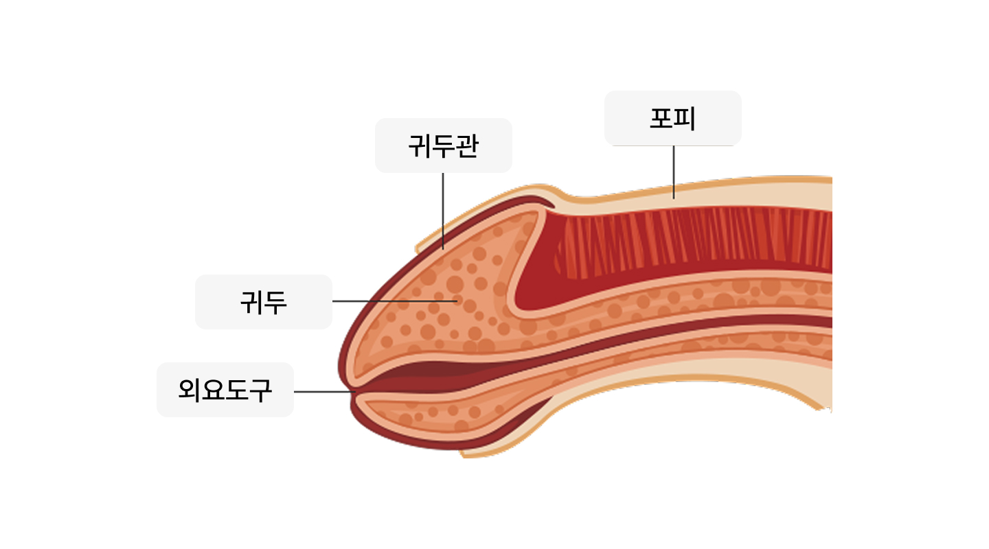 포피귀두염 일러스트