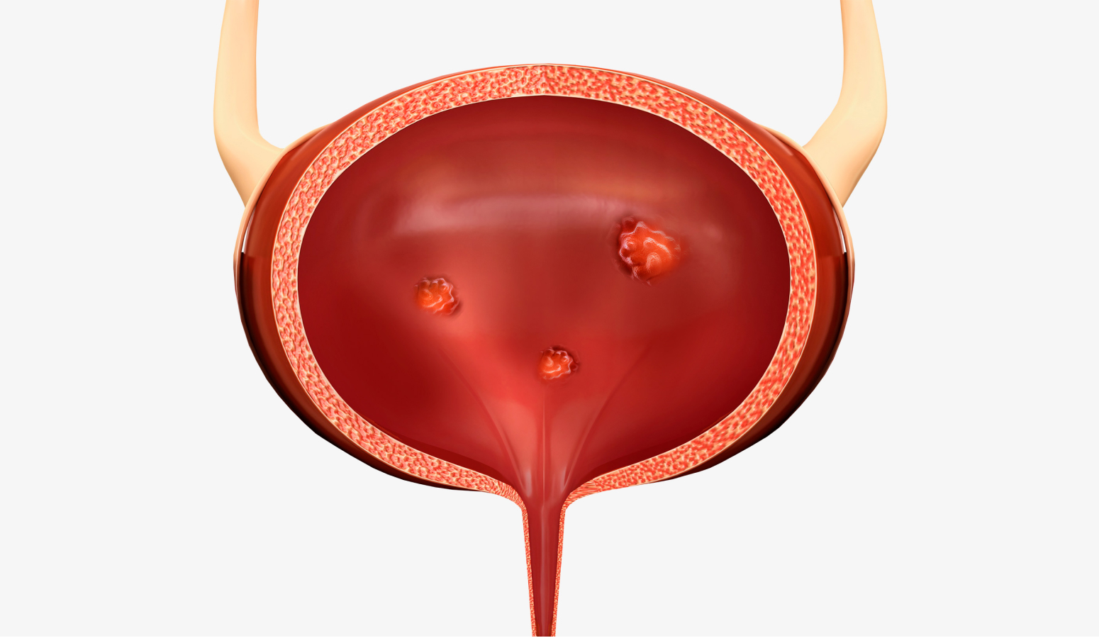 염증성 방광 일러스트