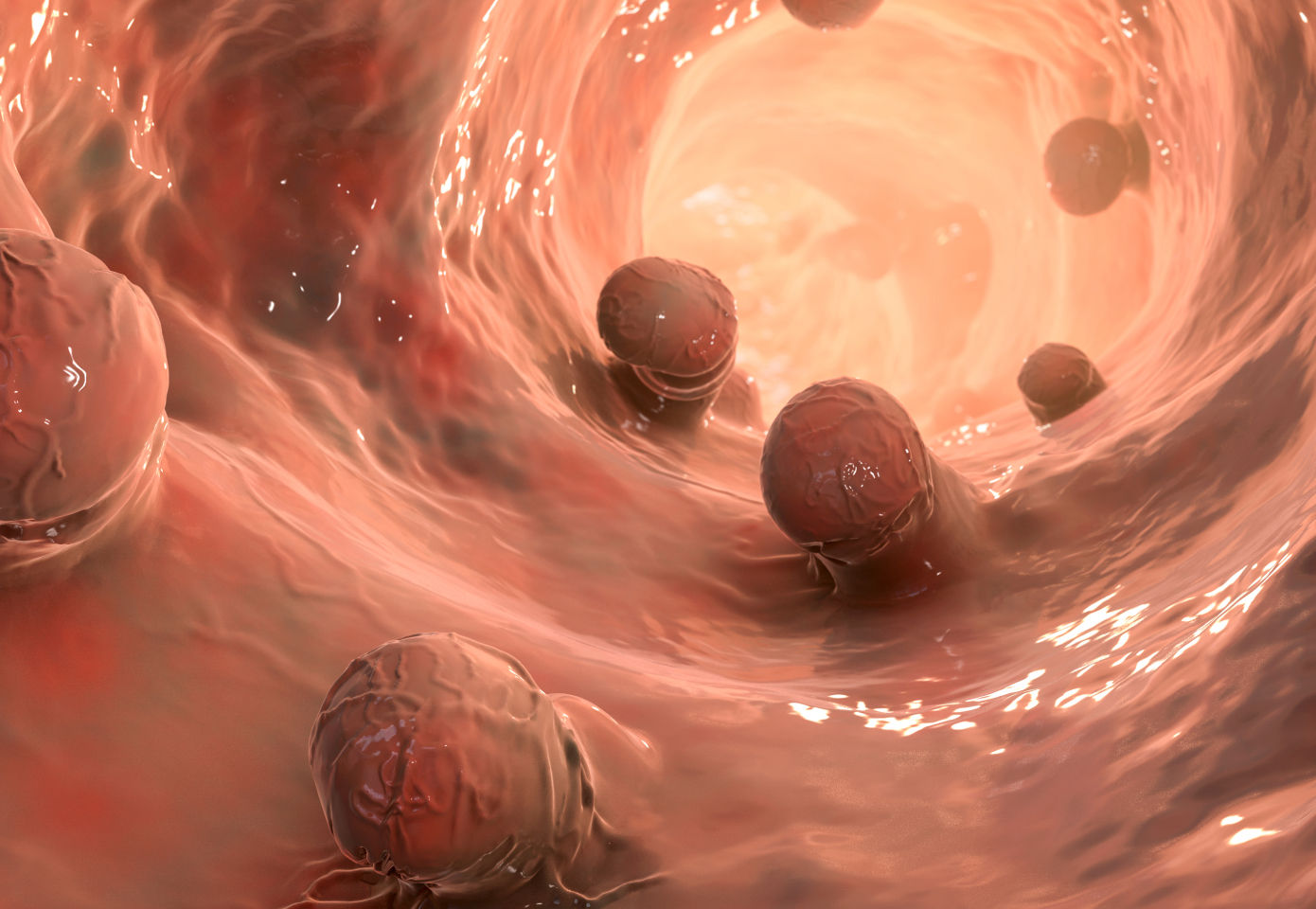 헌너 궤양 일러스트