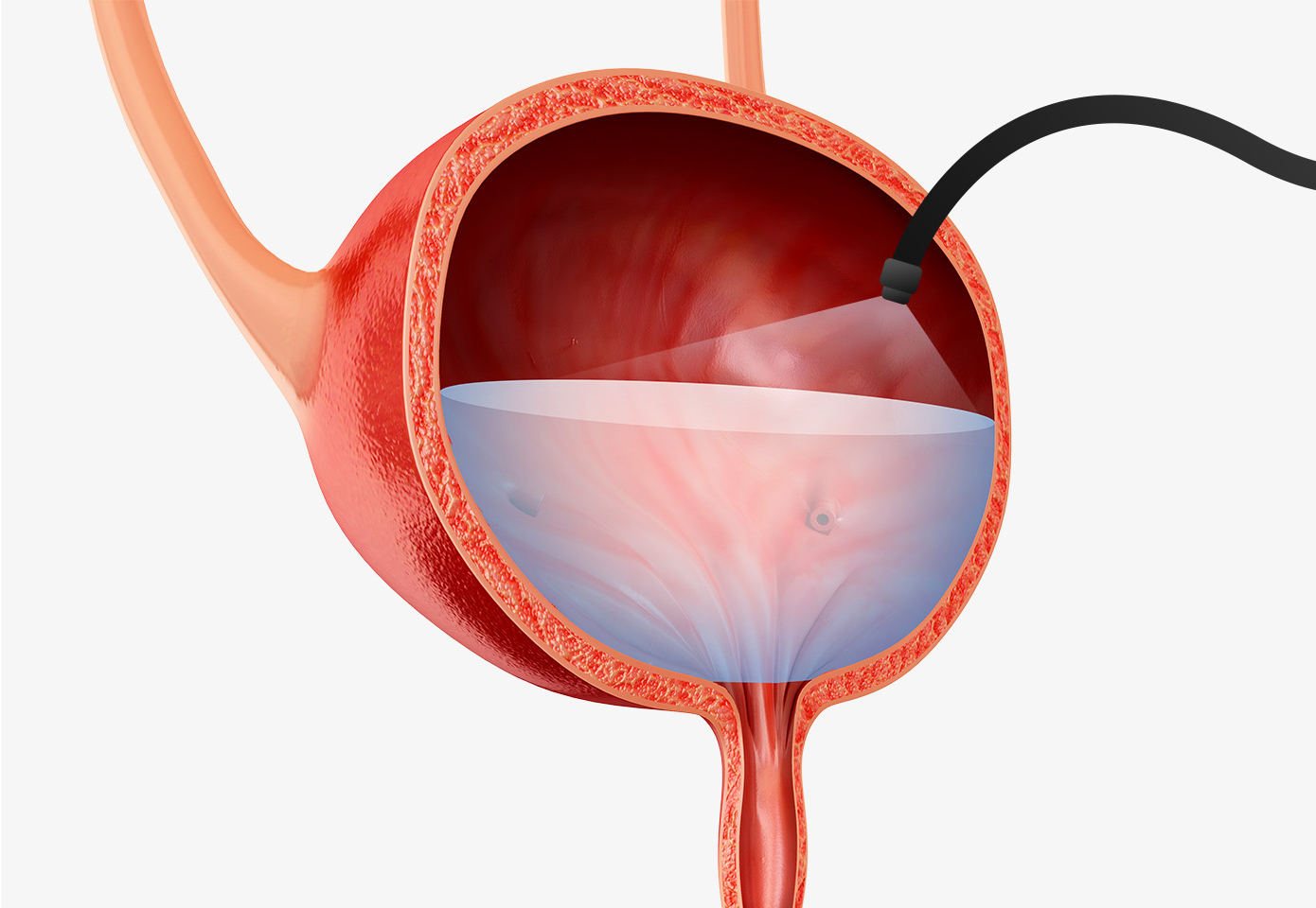 방광수압확장술 일러스트