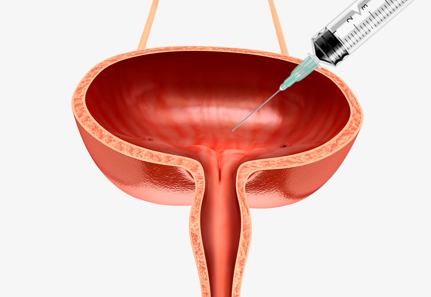 방광 보톡스 주입술 일러스트