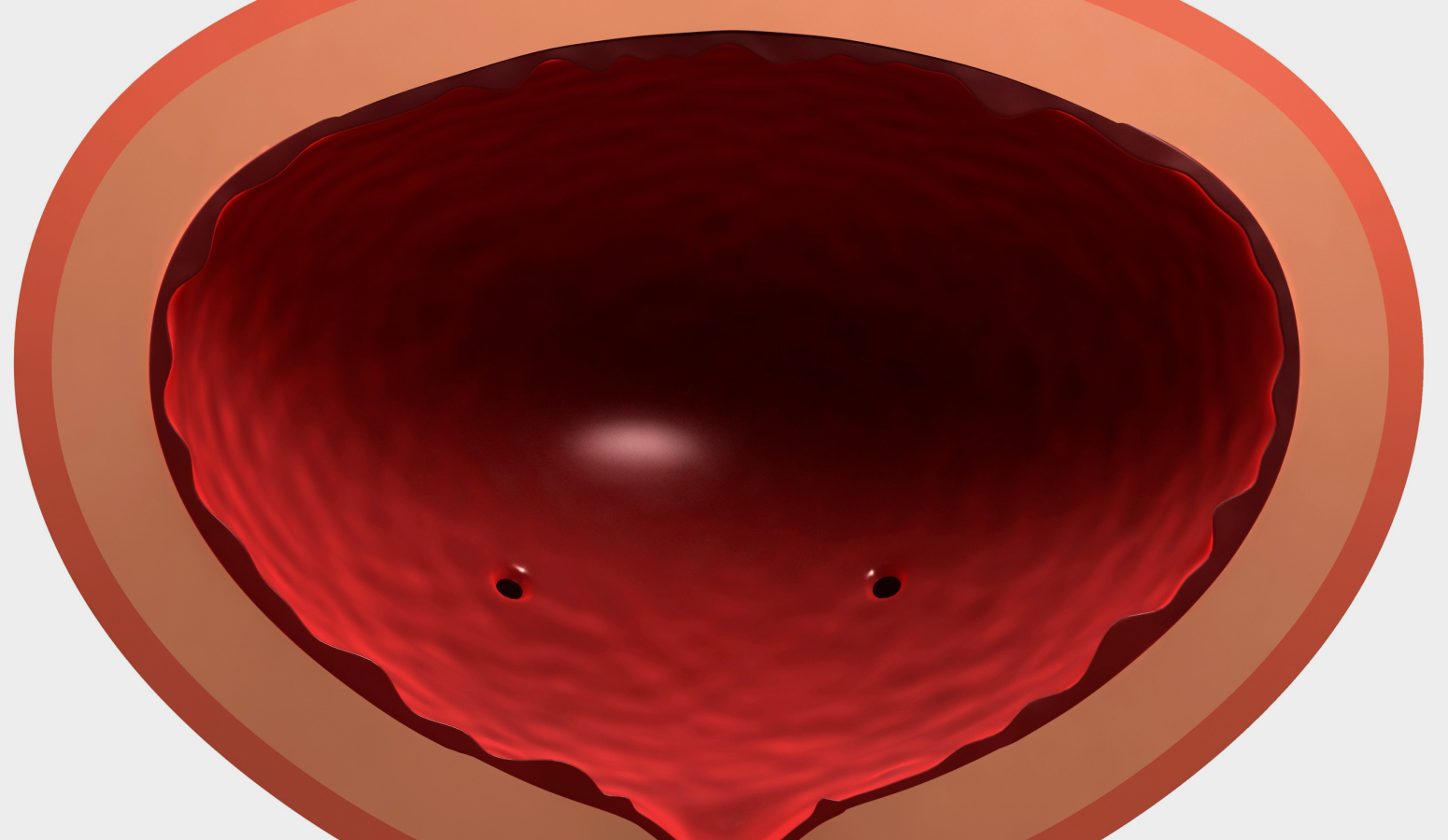 방광 상피층의 결함 일러스트