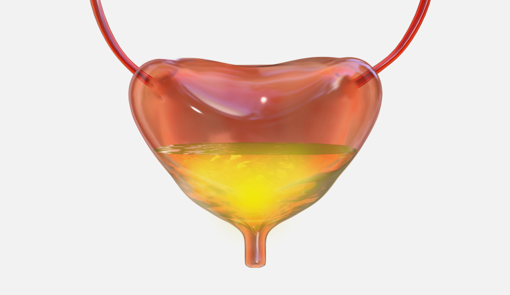 일류성 요실금 일러스트