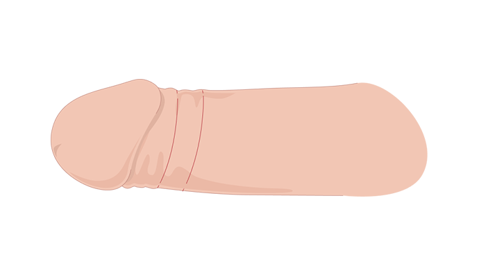 국소마취 일러스트