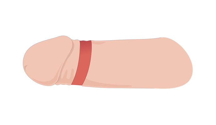 피부 제거 일러스트