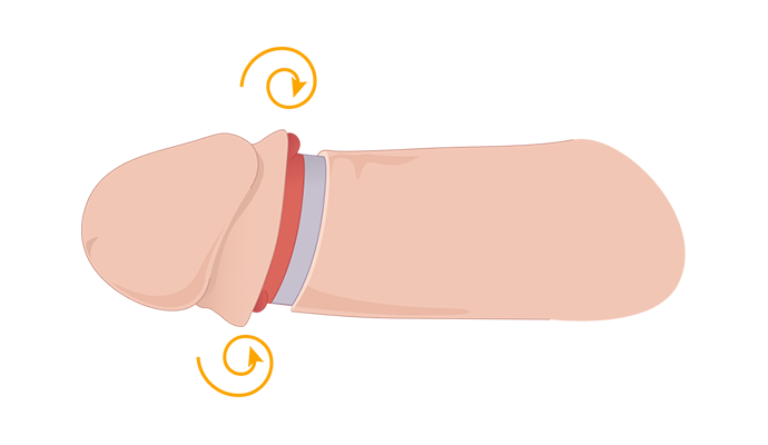 피부 밑 근박층 고정 일러스트