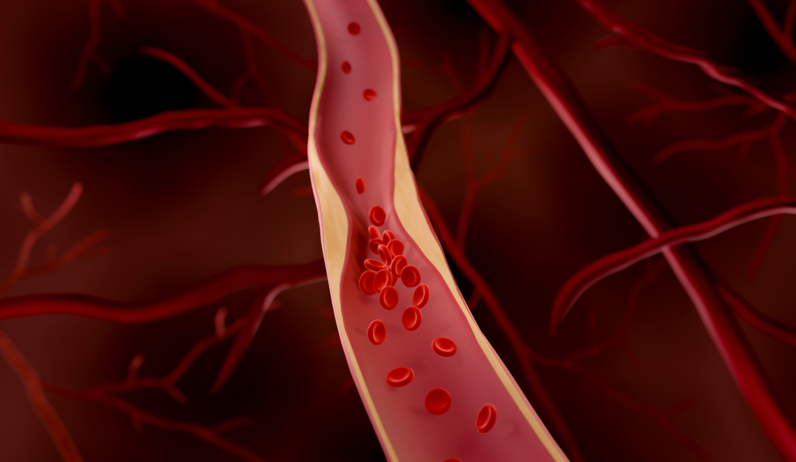 동맥경화 일러스트