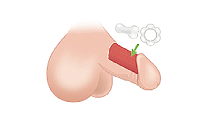 음경보형물 삽입술 일러스트