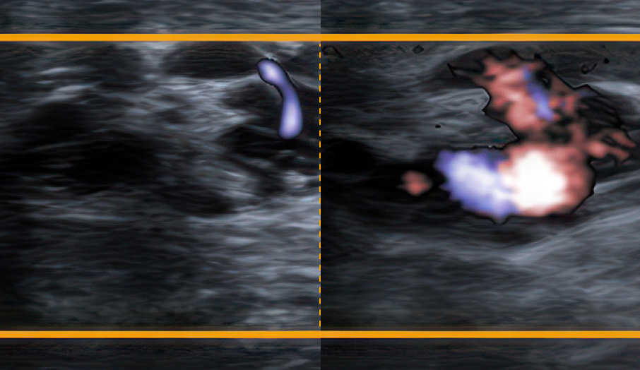 도플러 초음파검사 화면