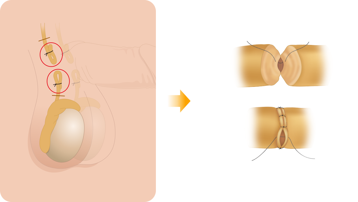 정관-정관문합수술 일러스트