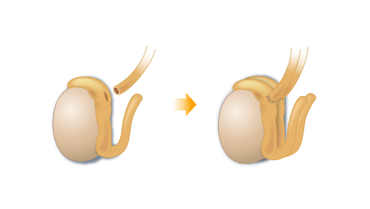 정관-정관문합수술 일러스트