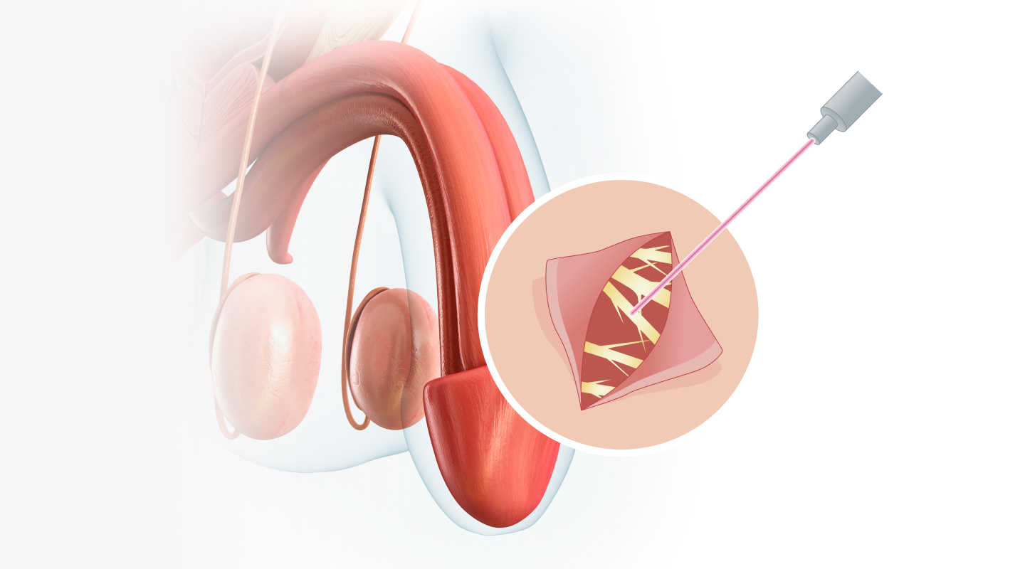 레이저 조루수술 일러스트