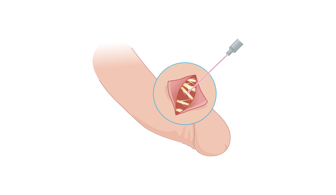 특정 배부신경 차단 일러스트