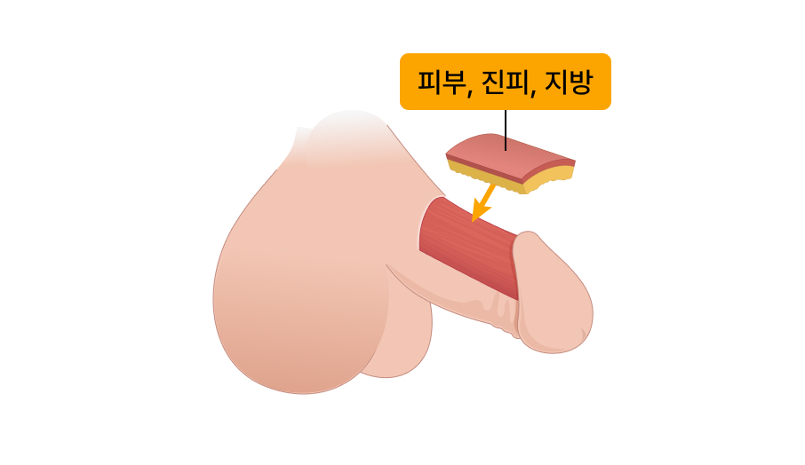 자가진피 음경확대술 일러스트