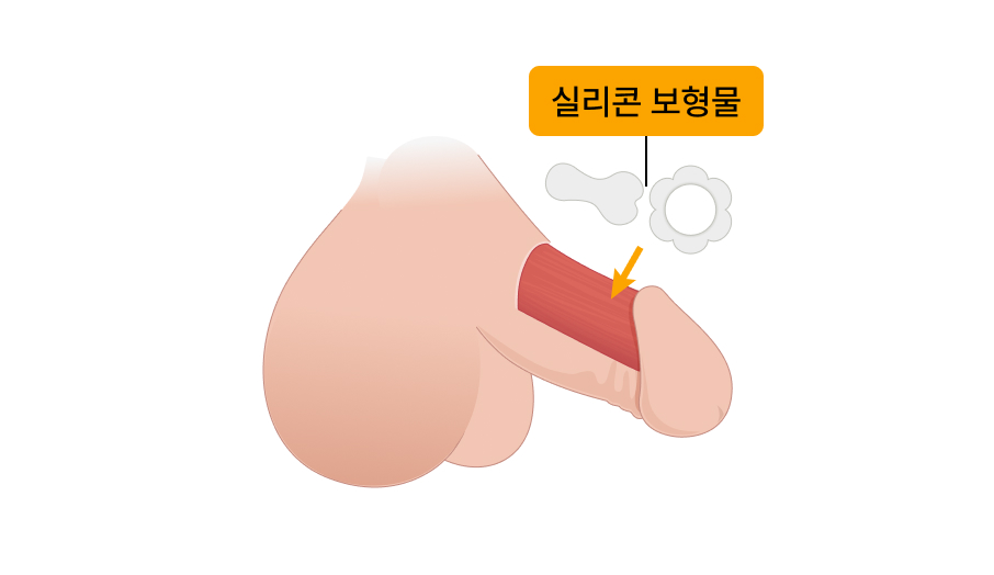 실리콘 보형물 음경확대술 일러스트