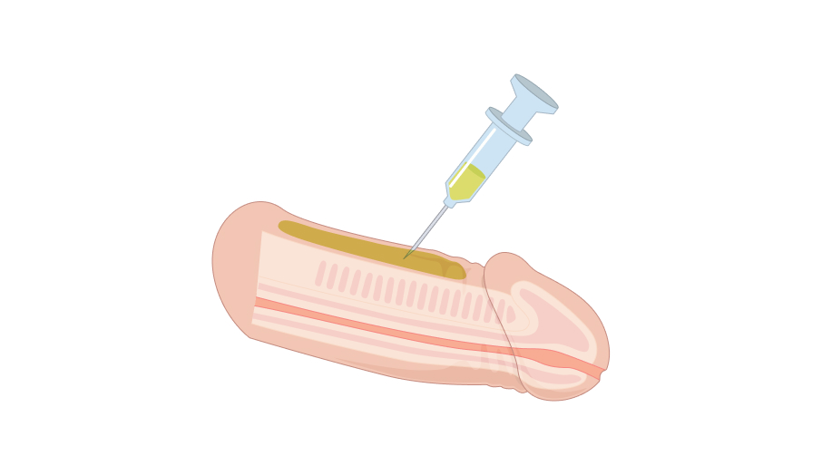 필러 음경확대술 일러스트