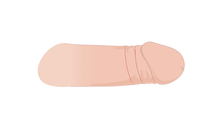 함몰음경확대술 일러스트