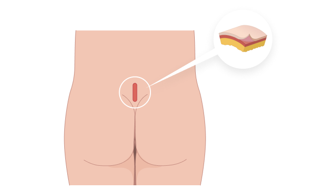 진피 채취 일러스트
