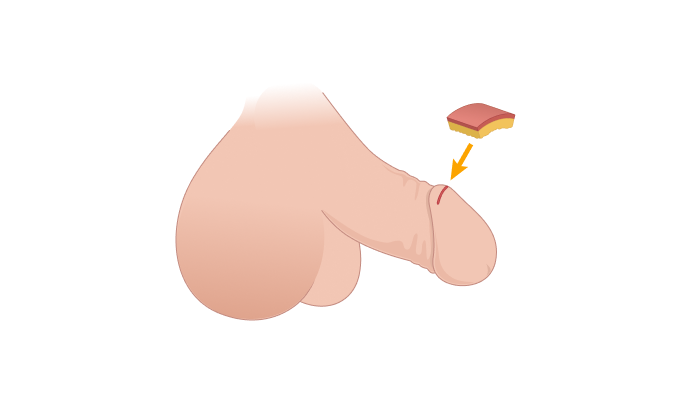 귀두 절개 일러스트