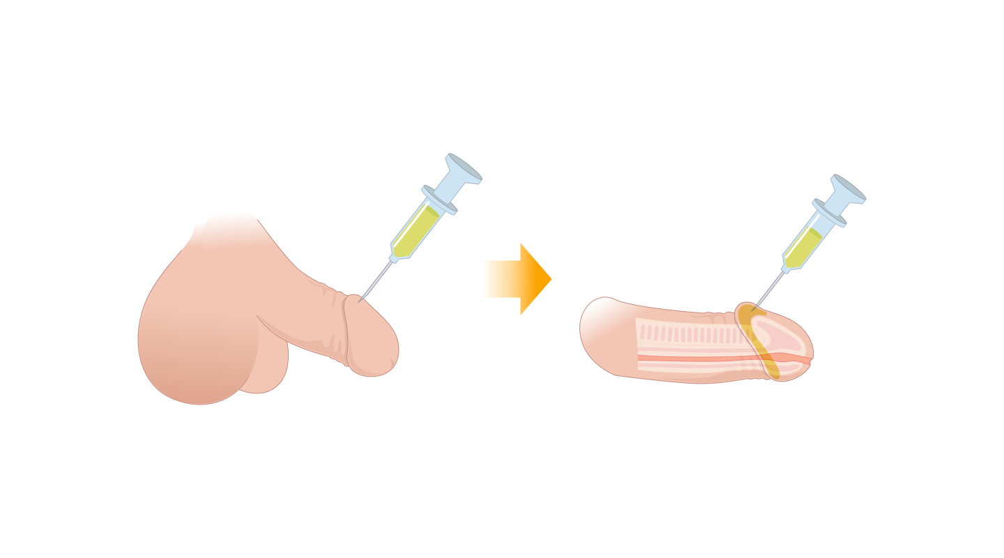 필러 귀두확대술 일러스트