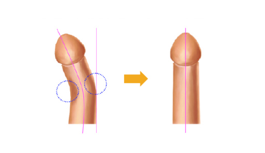 백막 성형술 일러스트