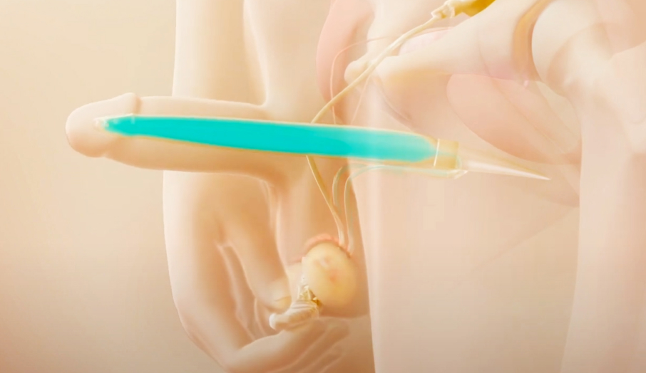 음경보형물 삽입술 일러스트