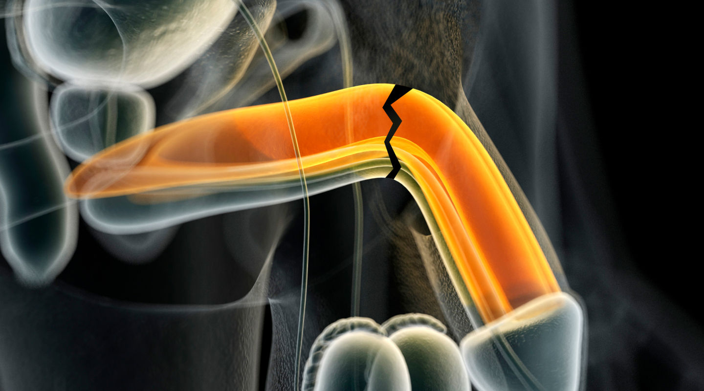 음경골절 상징 일러스트