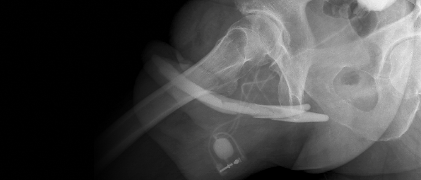 음경해면체 조영술 X-ray