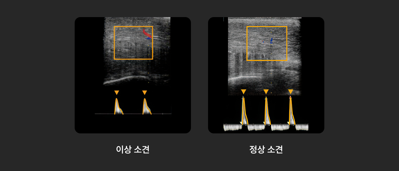 음경 도플러 초음파 검사 화면