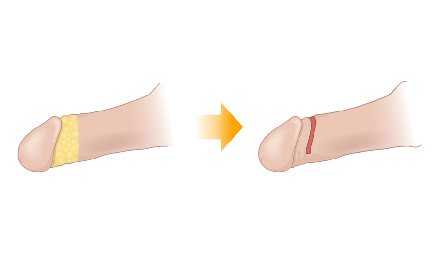 절제 후 피부 연장 수술 전후 일러스트