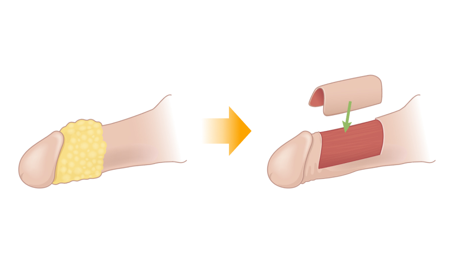 절제 후 피부 이식 수술 전후 일러스트