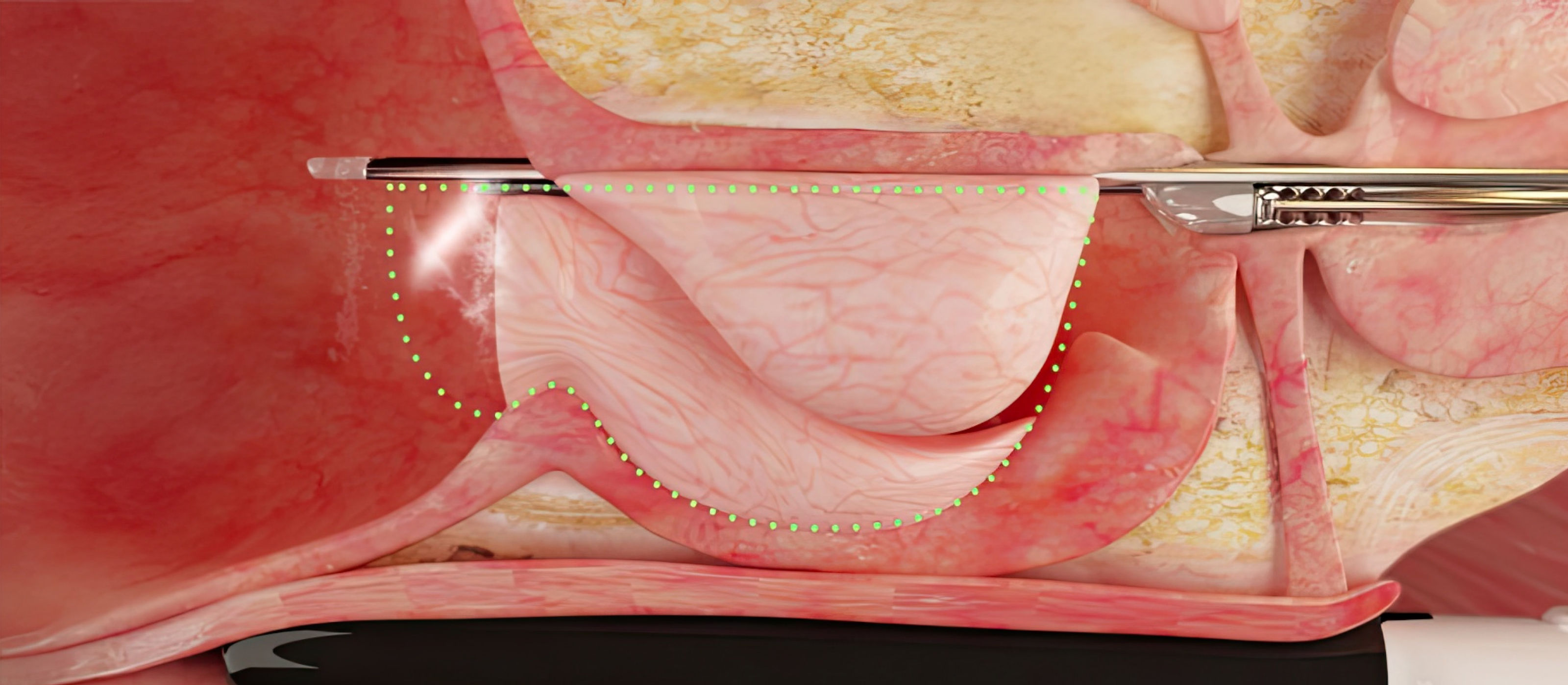 로봇 워터젯수술 장면 일러스트