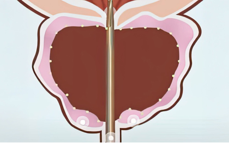 절제된 전립선 일러스트