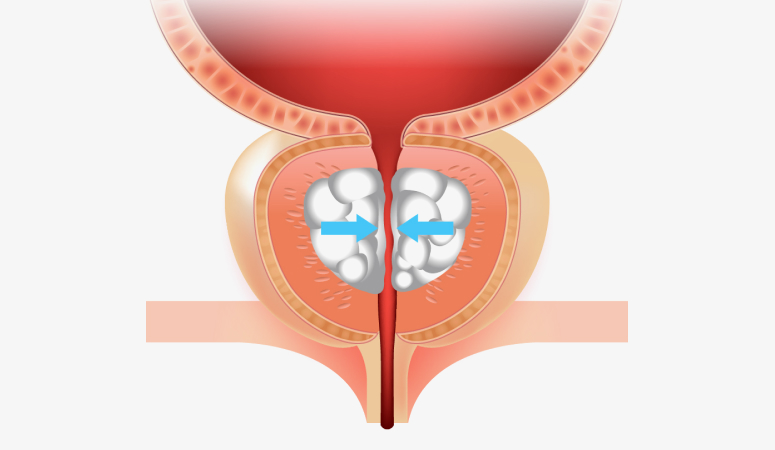 비대된 전립선 일러스트