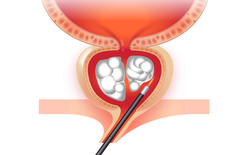 비대 조직 분리 일러스트