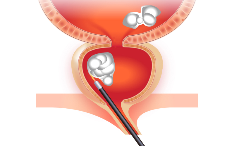 주변 혈관 지혈 일러스트