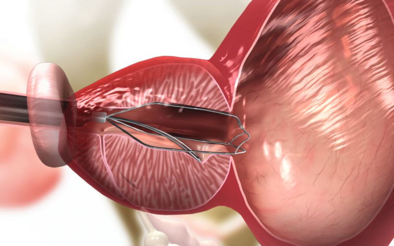 전립선 상태 확인 일러스트